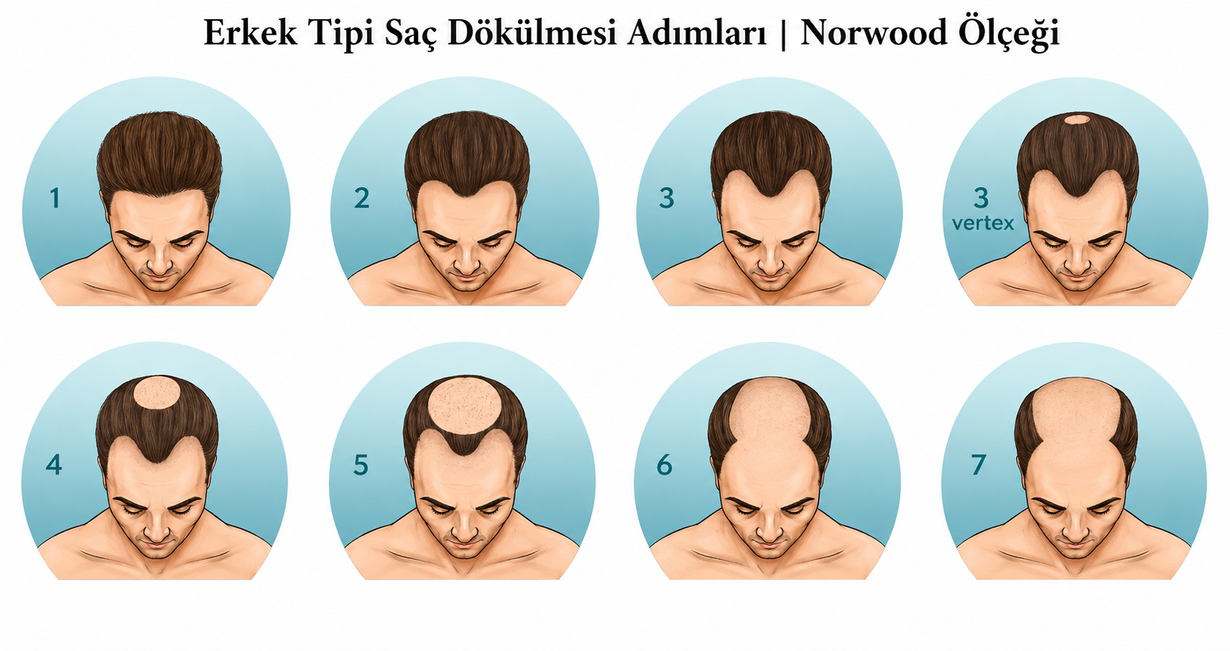 Male Pattern Hair Loss Stages - Norwood Scale